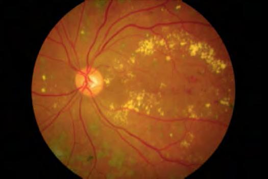 La retinopatia diabetica è una patologia cronica, progressiva della microvascolatura retinica associata a iperglicemia prolungata e ad