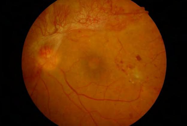 5.4 Retinopatia diabetica