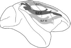 MODELLI ANATOMICI DEL NEGLECT VISIVO Deficit alle cortecce multimodali che contribuiscono alla formazione di