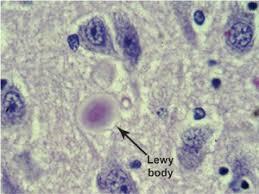 Demenza a corpi diffusi di Lewy (LBD) Lesioni presenti nell AD Presenza di corpi di Lewy diffusi Più frequente nei maschi Sintomi psichiatrici (allucinazioni e deliri) Segni extrapiramidali