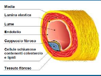 Tale placca si sviluppa all interno dell intima della parete arteriosa, evolve portando all ispessimento