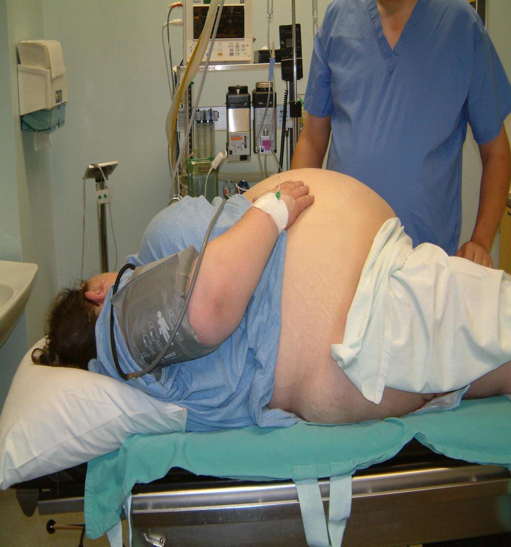 Il 31% delle donne decedute è obeso (IMC 30) e il 20% in sovrappeso (IMC 25-29) Ridurre l IMC prima