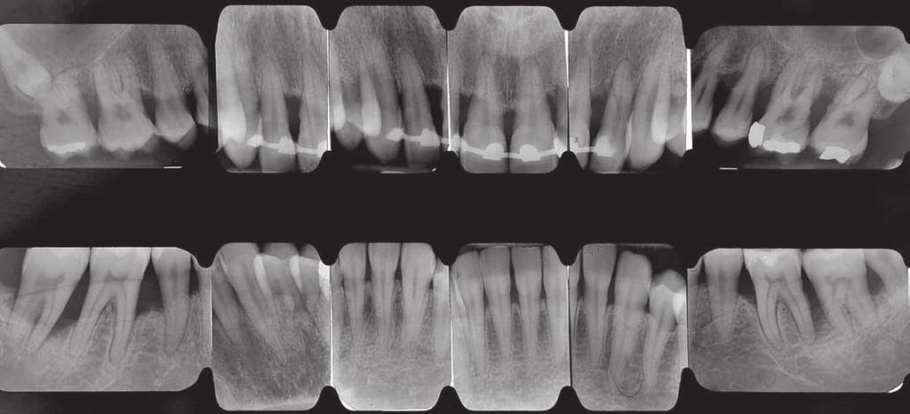 Il sondaggio delle tasche variava tra 2 e 8 mm. La diagnosi del caso è stata parodontite aggressiva generalizzata (C1.2).