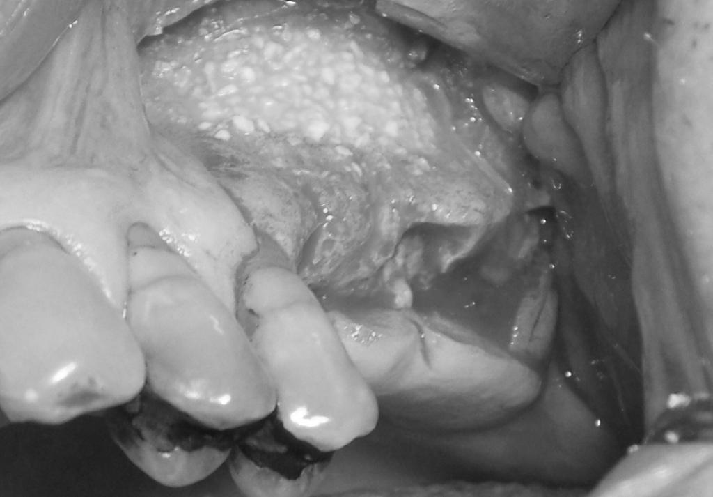 IL CORSO CHIRURGIA ORALE E IMPLANTARE 50 OBIETTIVO FORMATIVO DI SISTEMA: LINEE GUIDA - PROTOCOLLI - PROCEDURE ECM PRESENTAZIONE DEL CORSO 10 posti 50 ECM Aula Virtuale* 27-28 settembre 2019 25-26