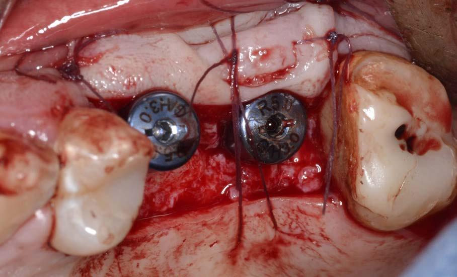 Strumentario chirurgico 6. Lembi di accesso e suture in chirurgia orale e implantare 7. Tecniche chirurgiche di inserimento implantare 8. Superfici implantari: interfaccia osso-impianto 9.