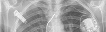 heart failure (88% in INTERMACS level