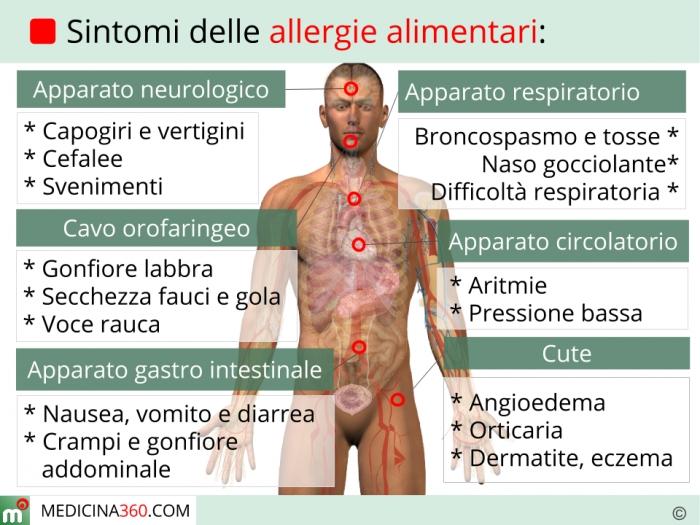 5 Sintomi di allergie alimentari I sintomi variano da lievi a gravi.