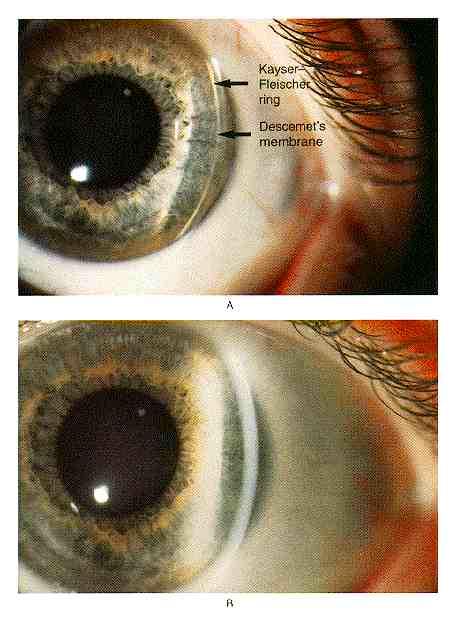 Malattia di Wilson: percorso diagnostico Anello di Kayser Fleischer Nel nostro Paziente: No KF ring Nessun