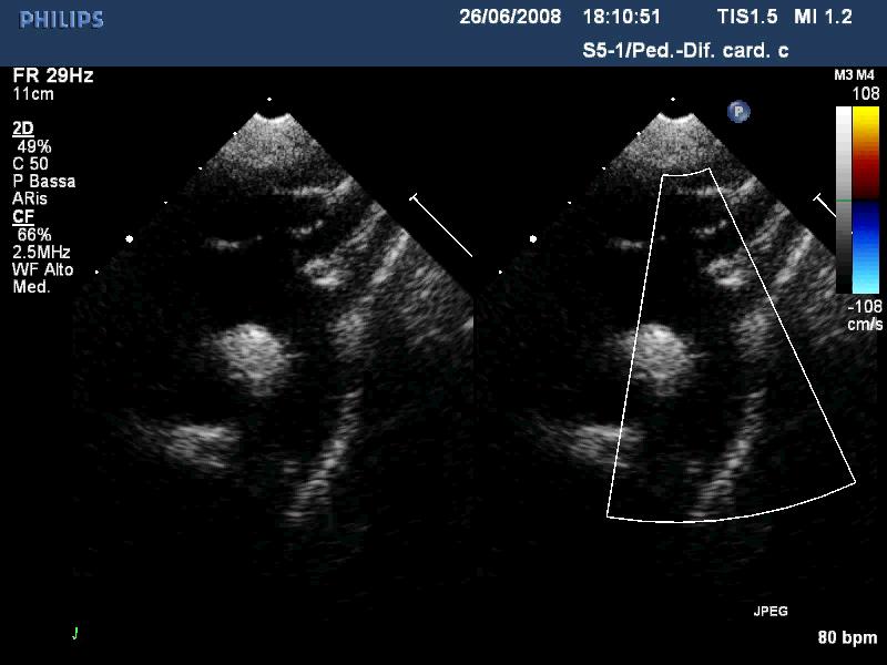 Si continua nell arco aortico da cui originano vasi epiaortici.