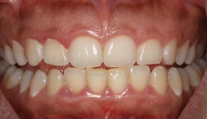 A sinistra. Gengivite prima della detratrasi (gengive lucide, arrossate, sensazione di dente tozzo dato dal gonfiore gengivale). A destra.