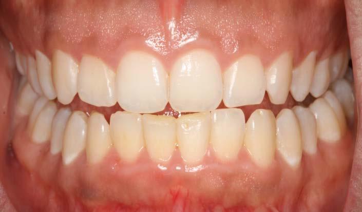 La seduta si concluderà con: 1) la lucidatura dei denti e delle zone radicolari con le coppette e pasta o apparecchi STUDIO a getto ODONTOIATRICO di polvere di bicarbonato.