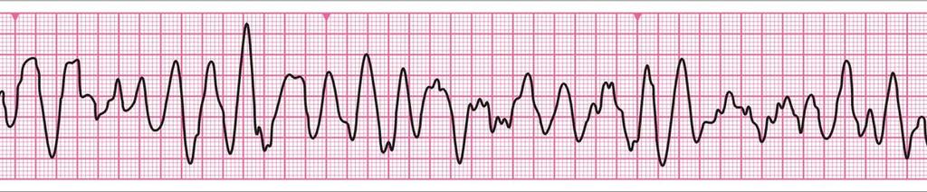 Fibrillazione Ventricolare FV/TV 1