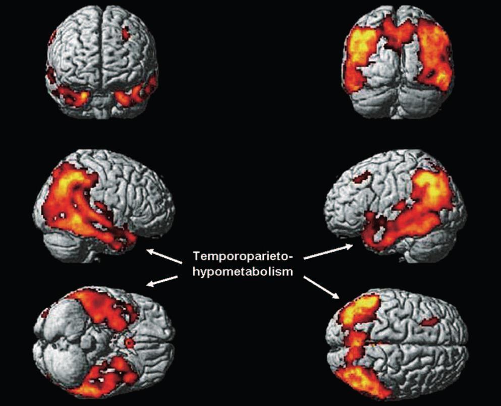 [ 18 F]FDG PET [ 18 F] FDG uptake: biomarker di neurodegenerazione Nella MA le aree che