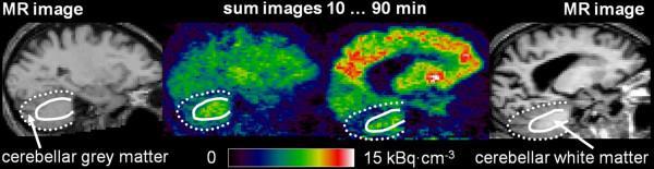 Amyloid imaging 90-95% dei soggetti con MA presenta aumentata deposizione di amiloide 60% dei soggetti con MCI sono amiloide positivi 25-30% dei soggetti