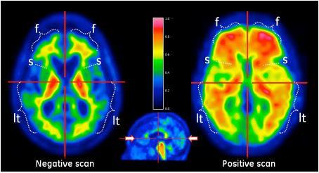 Amyloid imaging Neg Pos Neg Pos Criteri per l uso appropriato dell amyloid PET imaging: 1.