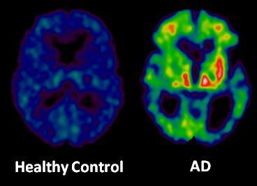 Imaging della neuroinfiammazione in MA e MCI PET con