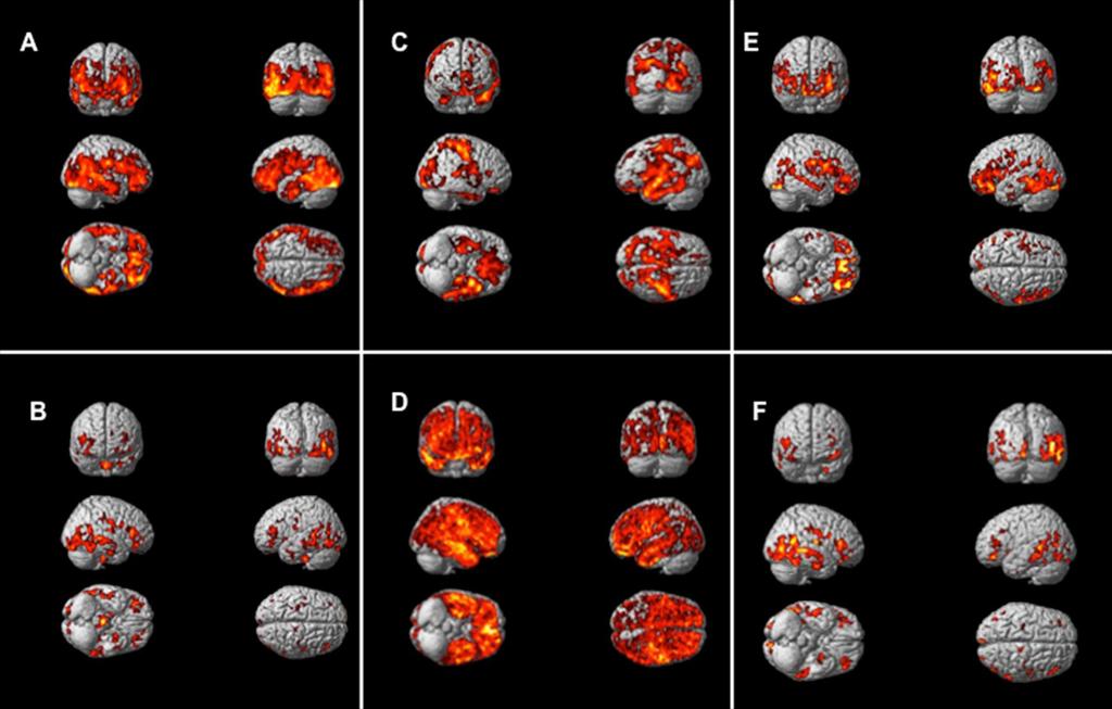 Neuroinfiammazione in MA e Parkinson-demenza Vol HIP vs PK11195 Vol