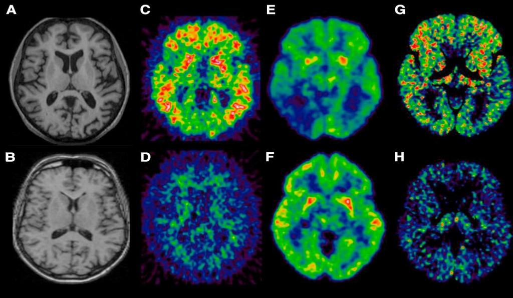 Neuroimaging: vantaggi e limiti - Valutazione in vivo dei processi patologici - Disponibilità e costi di PET/MRI - Identificazione precoce delle variazioni - Standardizzazione