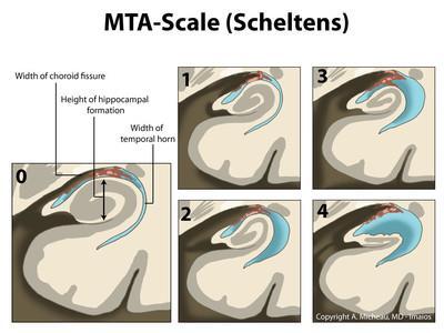 Imaging strutturale Ruolo della CT secondario (se MRI