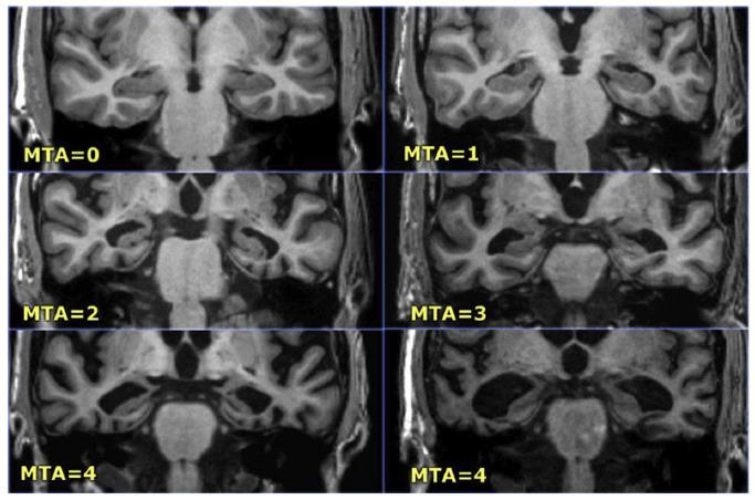 (stroke, tumori, patologie demielinizzanti) Valutazione