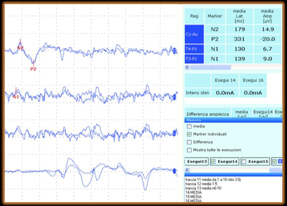 state valutate la latenza al punto di deflessione iniziale (LatN2) e l ampiezza media del potenziale al vertice N2-P2 nel suo complesso (AmpN2-P2) e nelle sue singole componenti (AmpN2 e AmpP2) e