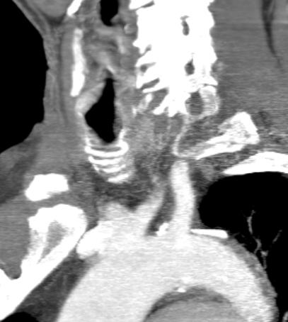 o Emiplegia destra, VII nervo cranico dx, sguardo deviato a