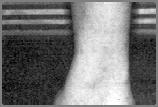 VARO - SUPINAZIONE soluzioni terapeutiche Il prolungamento del tacco (e della suola) verso l esterno viene utilizzato in presenza di un piede varo supinato VARO - SUPINAZIONE soluzioni terapeutiche