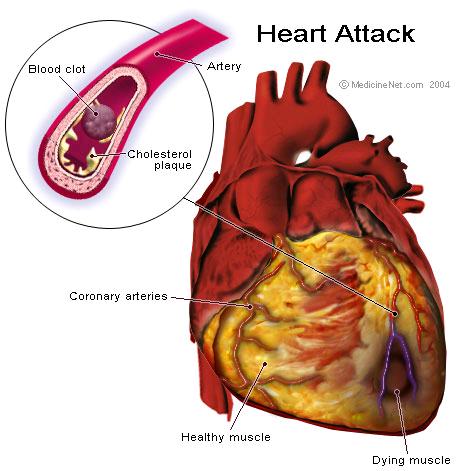 Acute Myocardial Infarction. 1 death every 36 seconds attributed to cardiovascular disease in the US 1.