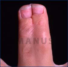 org/wiki/webbed_toes