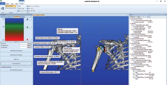 medicad Shoulder 3D Visualizzazione pre-operatoria e post-operatoria La pianificazione digitale con medicad Shoulder 3D permette al medico di prepararsi in modo ottimale all'intervento da eseguire.