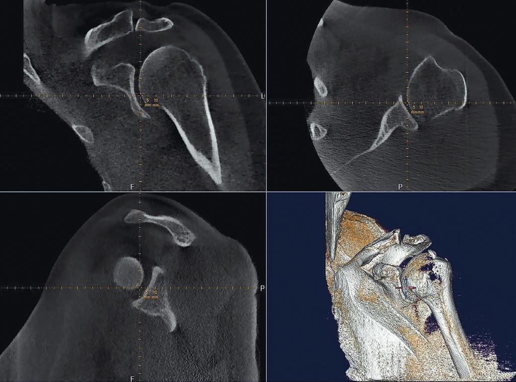 shoulder 3D Rappresentazione anatomica 3D e 2D medicad Shoulder 3D offre al medico diverse modalità di visualizzazione.