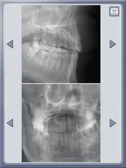 selezionato viene semplicemente posizionato sull'arcata dentale per