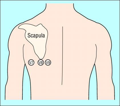Si usano gli stessi elettrodi usati per le altre precordiali (attenzione a specificare