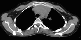 terapia: risposta parziale di malattia Parziale