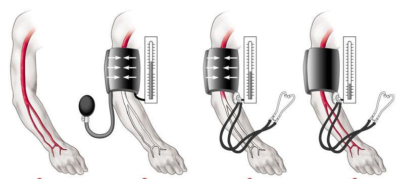 Tenere sotto controllo la pressione sanguigna è uno dei fattori di prevenzione delle malattie cardiovascolari Il valore normale della pressione sanguigna di un adulto è 120/70 mmhg (pressione