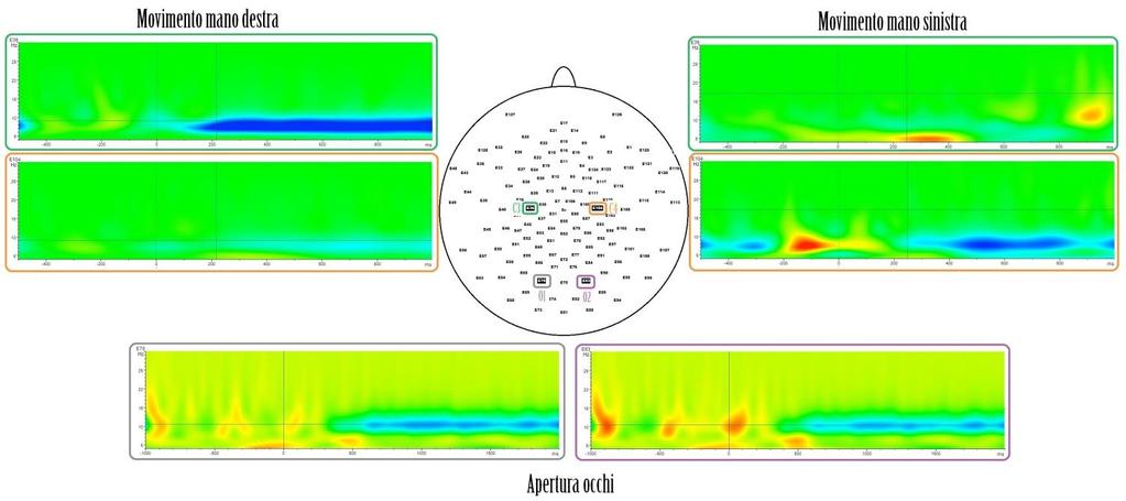 ottenuta attraverso l utilizzo della struttura ergonomica a risonanza propriocettiva Keope GPR è il ritmo µ, prevalentemente registrato dagli elettrodi 92, 93 e 104.