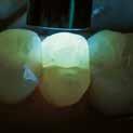 quando vengono esposti alla luce violetta, cosa che li rende facilmente distinguibili dalla struttura del dente naturale.