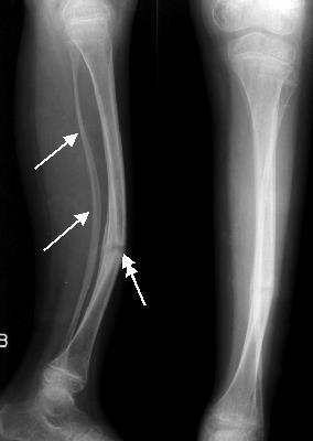Osteogenesi imperfetta L anomalia di base di tutte le forme di OI è la presenza di quantità di osso troppo scarsa che portano ad