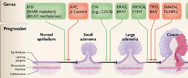 Trasformazione neoplastica nel colon Lo sviluppo del