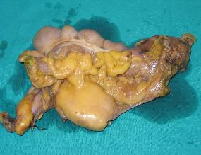 N: presenza o assenza di neoplasia nei linfonodi locoregionali (metastasi).