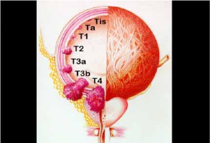 Cancro della vescica: T Ta Tis Carcinoma papillare non invasivo Carcinoma in situ: tumore piatto T1 Tumore che invade il connettivo sottoepiteliale T2 T3 T4 Tumore che invade il muscolo T2a: ½