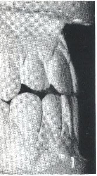 con tagli verticali che risalgano in ogni spazio interdentale, avendo cura di separare tutti i denti senza eliminare gesso a livello dei punti di contatto.