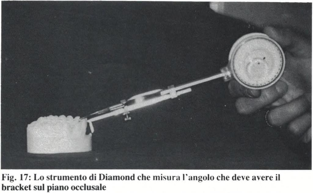 Ponendo lo strumento di Diamond sul modello con indice della livella sullo 0, detto strumento risulta parallelo al «piano occlusale modelli», mentre la pinzetta di posizionamento risulta inclinata e
