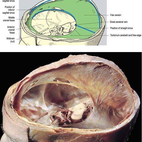 Faccia superiore del Tentorio 14 Quindi il tentorio cerebellare crea due compartimenti: il COMPARTIMENTO SOPRA- TENTORIALE che è suddiviso ulteriormente dalla grande falce cerebrale in due parti che