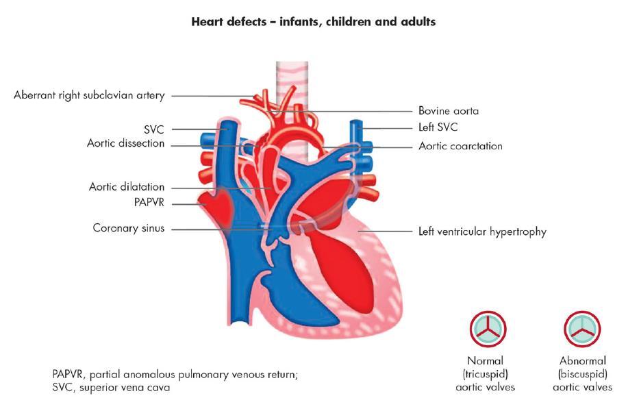 Patologia Cardiovascolare Panoramica di difetti cardiaci congeniti 22-70% Principale determinante della ridotta aspettativa di vita in pazienti Turner; 32-42% Up to 17% (0.