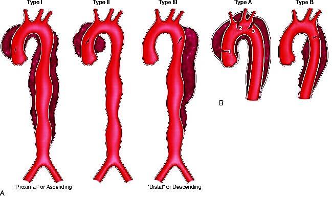 Patologia Cardiovascolare Principali difetti cardiaci acquisiti Dissezione aortica Nel 63% dei casi, gli episodi di dissezione aortica interessano l aorta ascendente (Stanford A e DeBakey I e II),