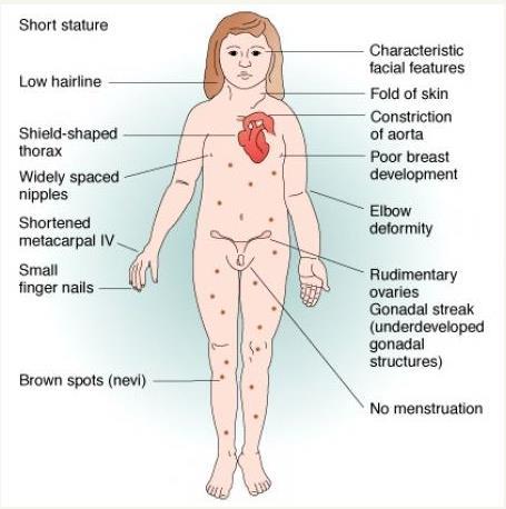 Sindrome di Turner Breve panoramica III Cardiovascular Issues in Turner Syndrome Coffee Break 02/12/2016 Caratteristiche fenotipiche post-natali Bassa statura 95-100% -SHOX gene- Infertilità 95% POF