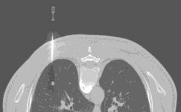 Visita oncologica 15/10/2014 PSA : 4,07 (6/2014) 1,3 (9/10/2014) ng/ml Ematochimici: emocromo, parametri di funzionalità renale ed epatica, coagulazione nella norma Programmata FNA lesione polmonare