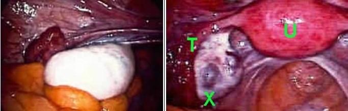 vescichetta sulla superficie dell ovaio l ovocita in 10 minuti