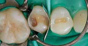 Otturazioni in composito insufficienti